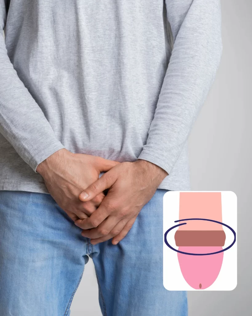 Paraphimosis