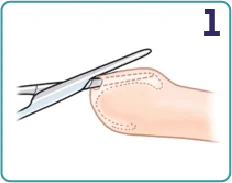 Traditional circumcision step 1