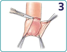 Traditional circumcision step 3